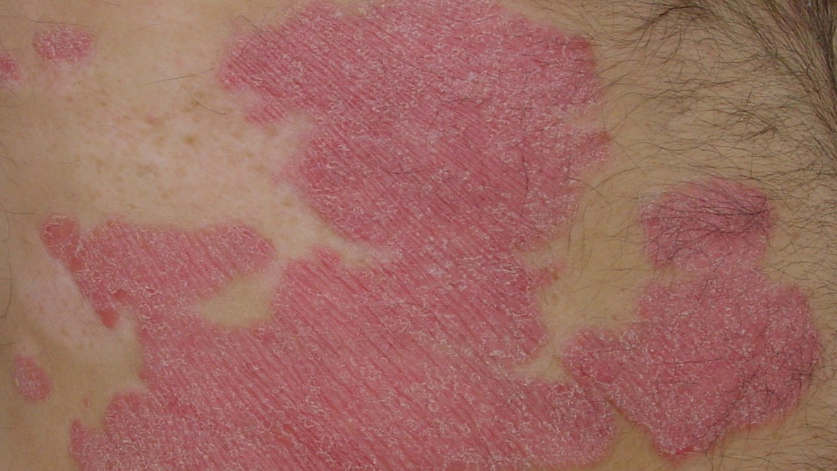 Psoriasis